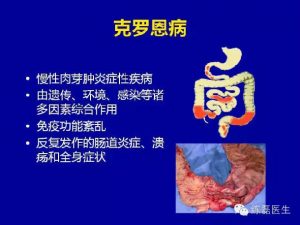 造口在克罗恩病中的应用-适应症与回纳时机