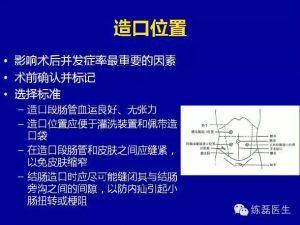 造口在克罗恩病中的应用-适应症与回纳时机